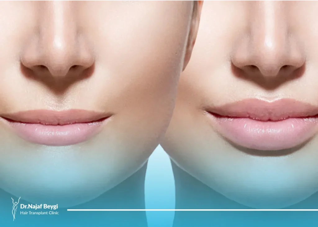 انواع لیفت و بالا کشیدن لب ها