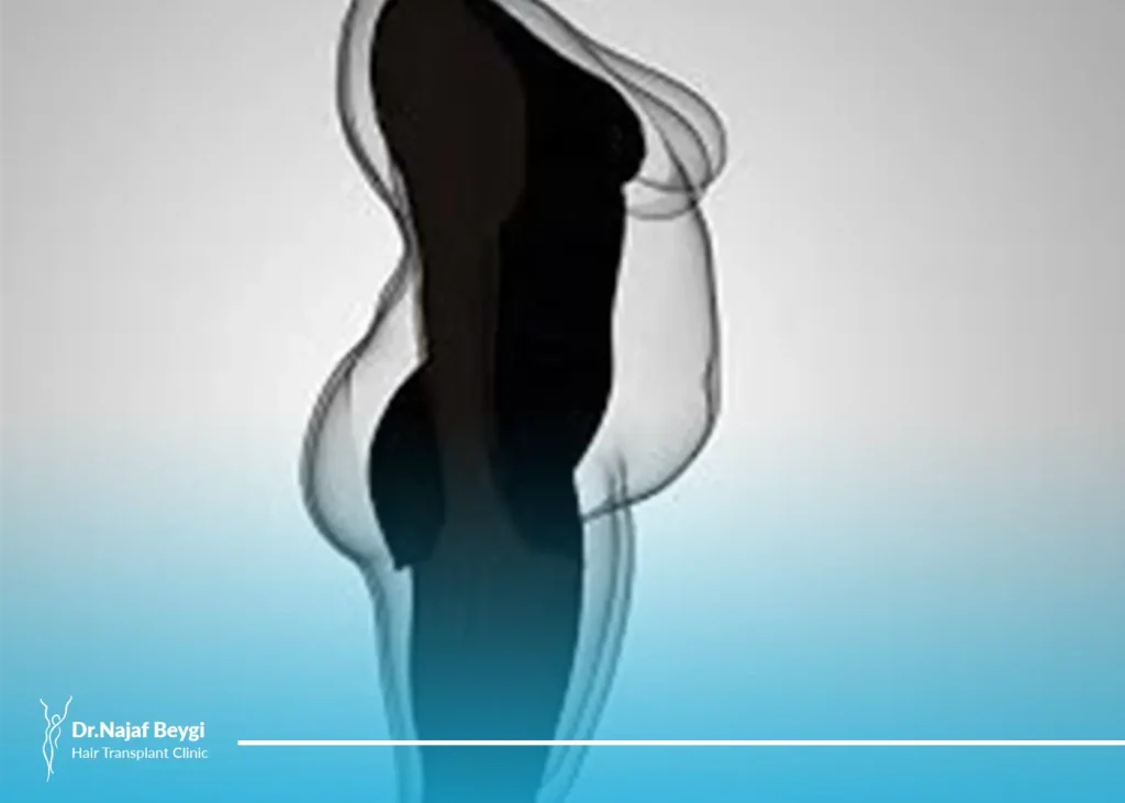 آشنایی کامل با انواع عمل ابدومینوپلاستی یا جراحی زیبایی شکم