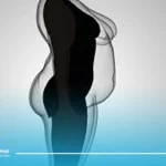 عمل ابدومینوپلاستی