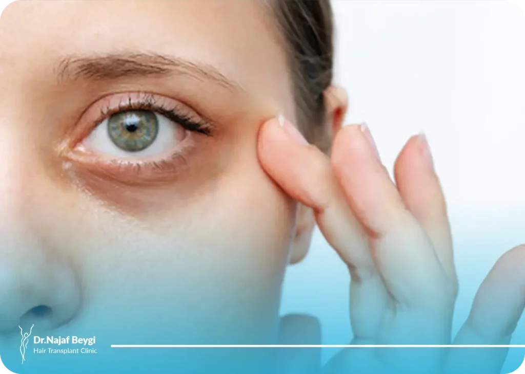 درمان گودی زیر چشم