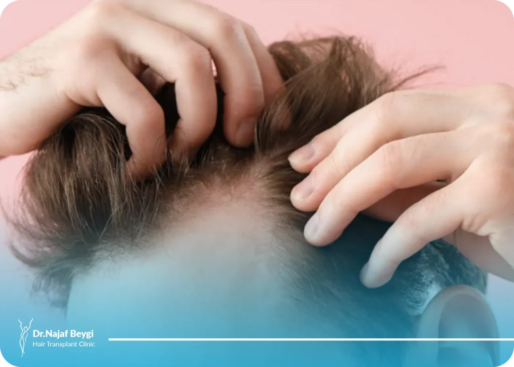 بررسی بهترین زمان رنگ کردن موها پس از کاشت مو