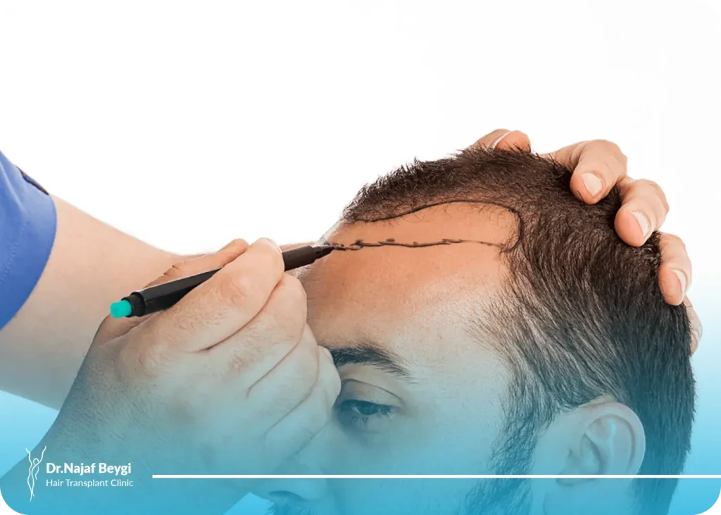 کاشت مو به روش  تکثیر: تحولی بزرگ در آینده جراحی کاشت مو