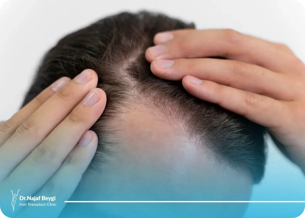 بهترین سن برای کاشت مو چه سنی است؟