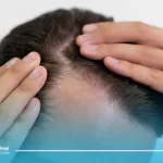 بهترین سن برای کاشت مو