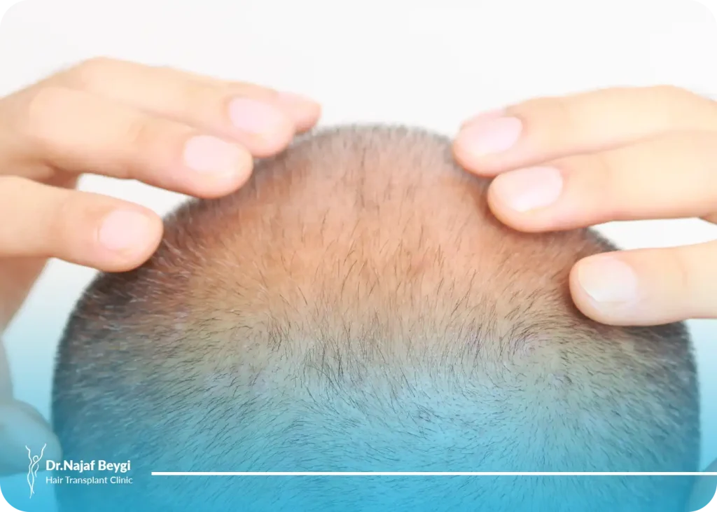 آیا ریزش مو بعد از کاشت مو طبیعی است؟ + نحوه درمان آن