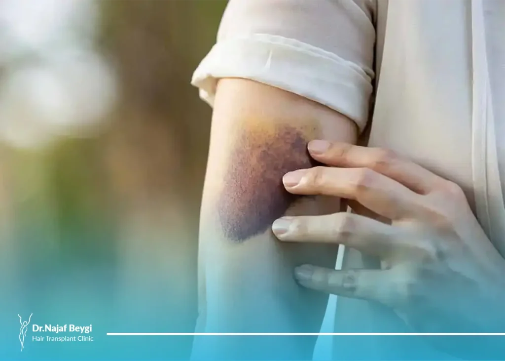 درمان کامل ورم و کبودی بعد از عمل لیپوماتیک