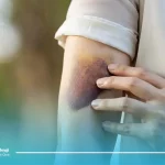 کبودی بعد از عمل لیپوماتیک