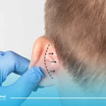 مراقبت های بعد از جراحی گوش