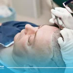 علت بی حسی سر بعد از کاشت مو