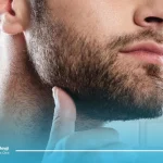 کاشت مو از ریش به سر