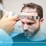 کاشت مو بیمار هپاتیت و ایدز