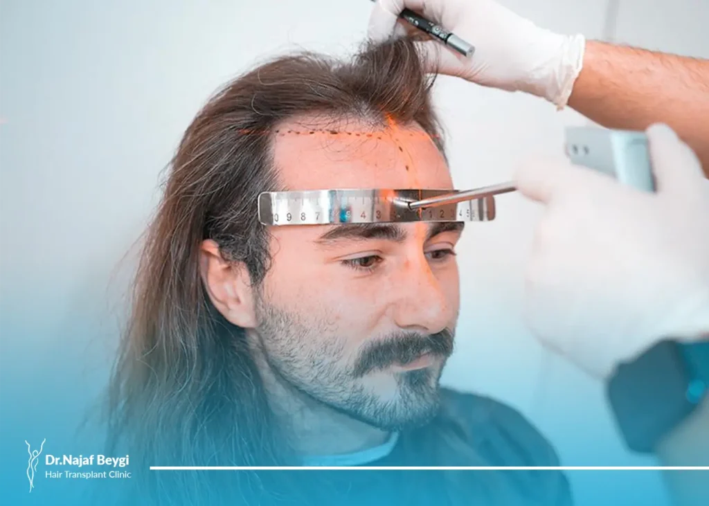 کاشت مو به روش نئوگرافت Neo Graft،جدیدترین شیوه کاشت مو در جهان