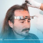 کاشت مو به روش نئوگرافت