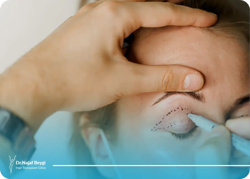 درمان افتادگی پلک با لیزر + مزایا، معایب و ماندگاری