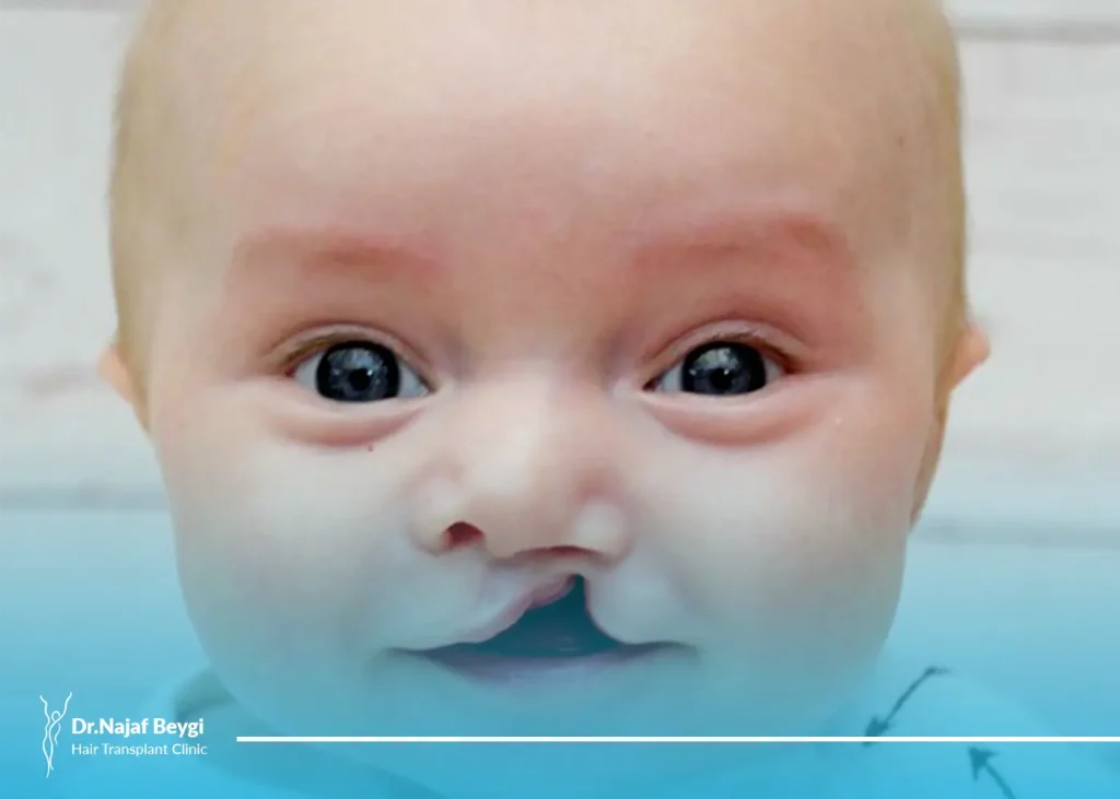 جراحی و ترمیم لب شکری (لب شکافته) و کام شکافته