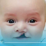 جراحی و ترمیم لب شکری