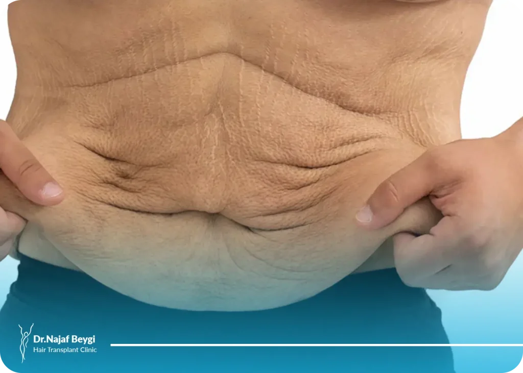آیا ابدومینوپلاستی پس از کاهش وزن شدید موثر است؟