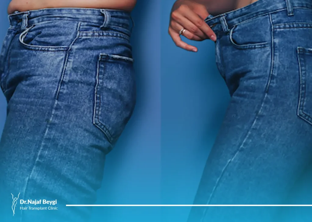 راه های مقابله با آمبولی بعد از عمل لیپوماتیک