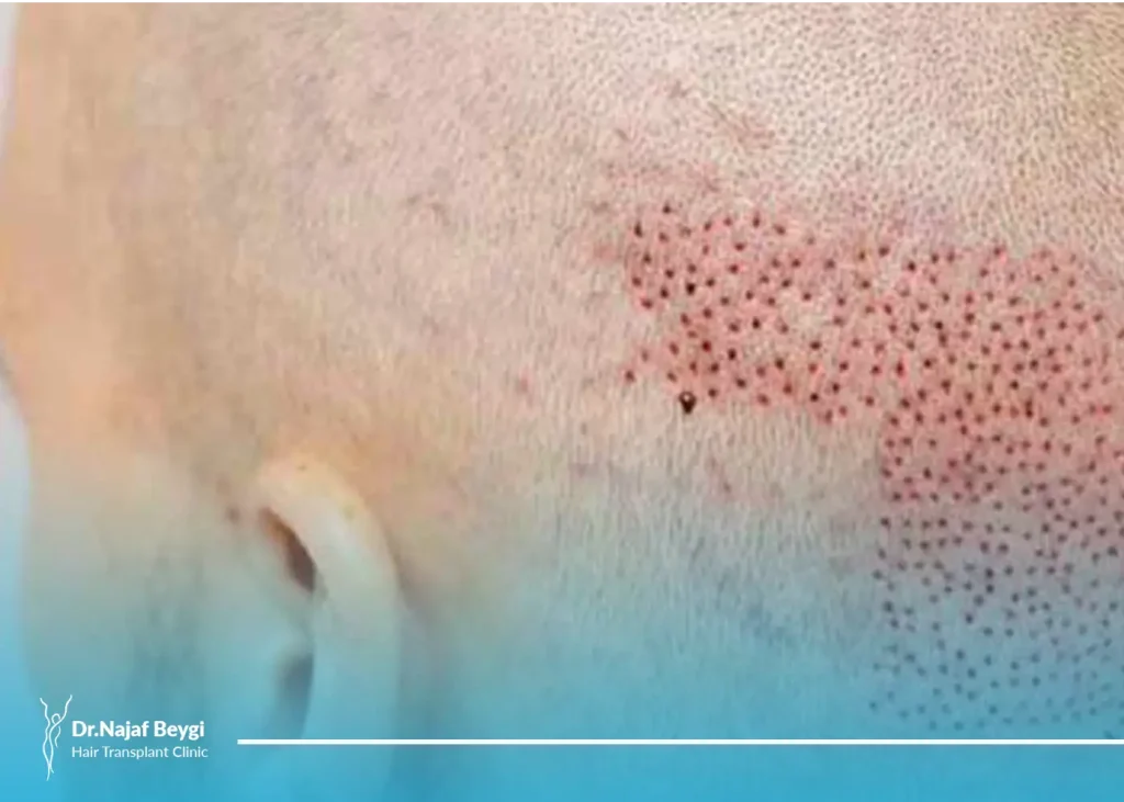 بانک مو چیست و در کجای سر قرار دارد؟