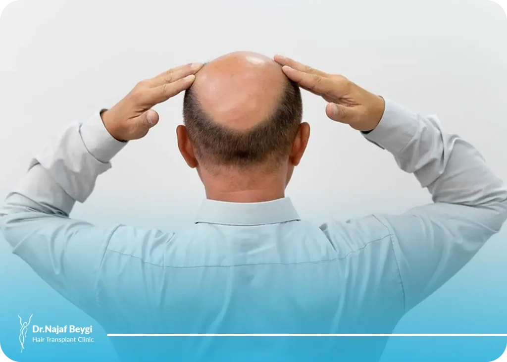 جدیدترین تکنیک برای کاشت مو در ناحیه ورتکس