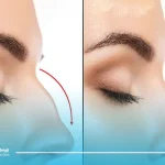 خطرات جراحی بینی برای افراد دیابتی