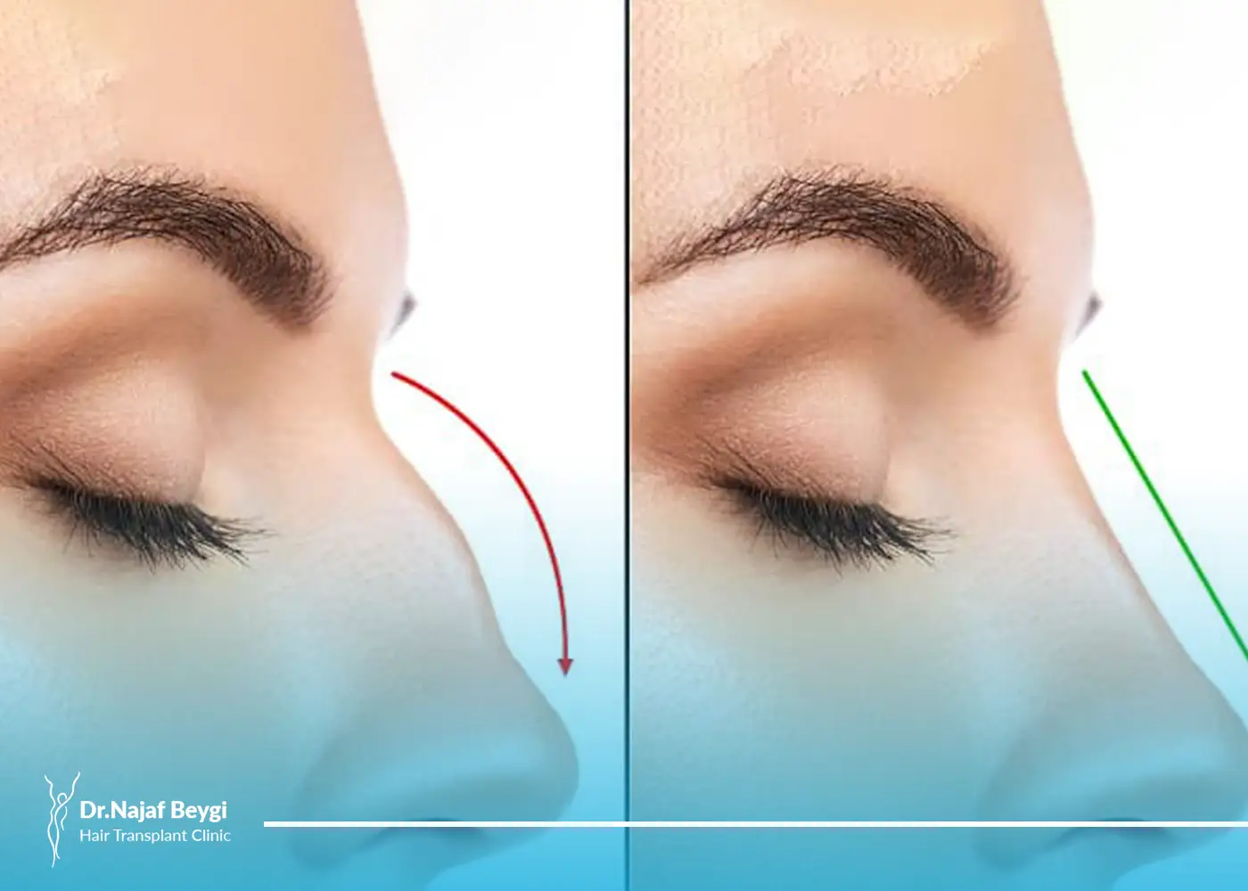 خطرات جراحی بینی برای افراد دیابتی