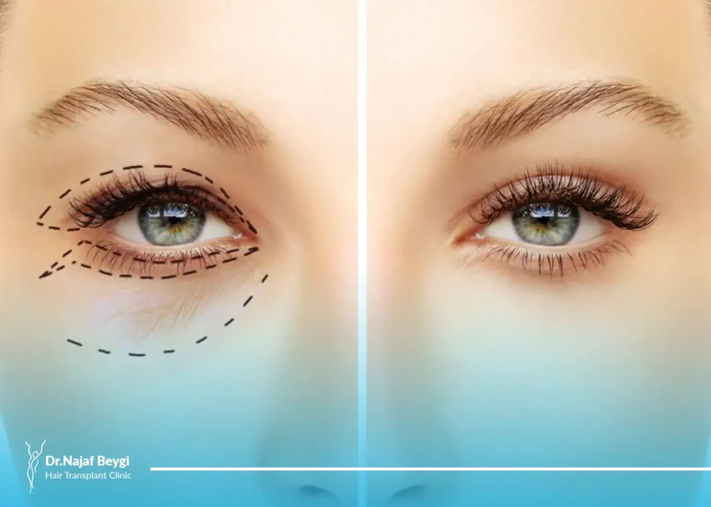 بررسی کامل بلفاروپلاستی با پلاسما جت + مزایا، معایب، ماندگاری و هزینه آن