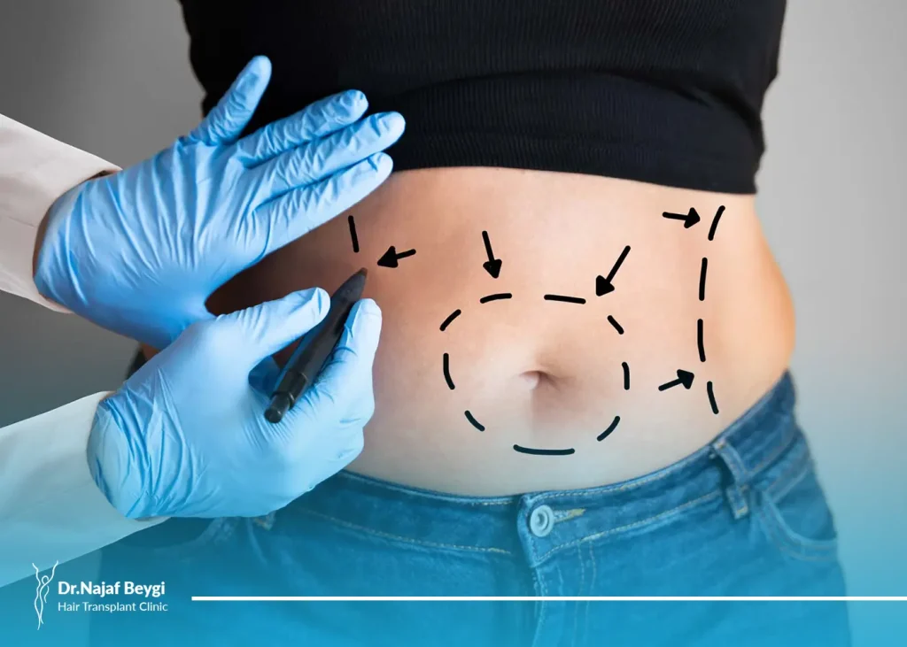 مينی ابدومينوپلاستی چیست؟ بررسی ریز به ریز آن