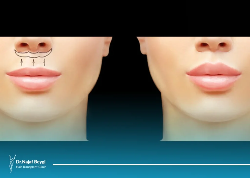 روش های از بین بردن جای بخیه سانترال لب