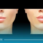 از بین بردن جای بخیه سانترال لب