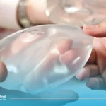 علائم عفونت پروتز سينه