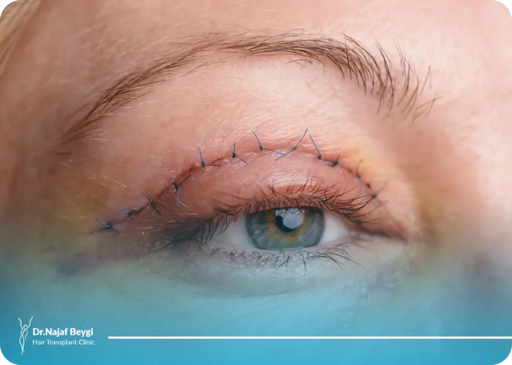 عوارض عمل بلفاروپلاستی را بشناسید!