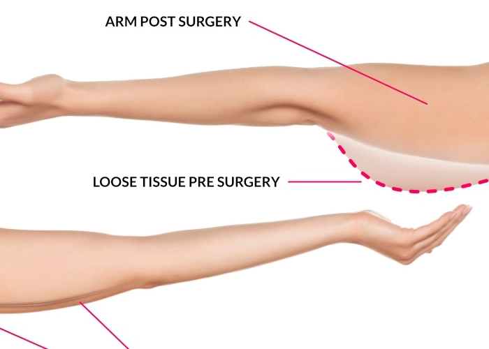 لیفت بازو یا جراحی لاغری بازو