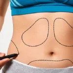 تخلیه چربی شکم چیست؟ آیا همان بوکال فت شکم است؟