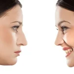 چه کسانی برای جراحی بینی مناسب هستند