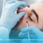 قوز بینی