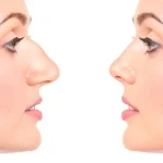 علت قوز بینی در دوران بلوغ