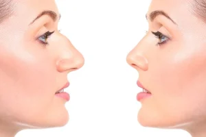 علت قوز بینی در دوران بلوغ | چرا بینی در نوجوانی تغییر میکند؟