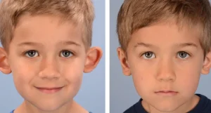 هزینه اتوپلاستی گوش در سال ۱۴۰۳ | راهنمای کامل عمل زیبایی گوش