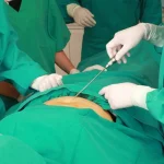 تخلیه خونابه بعد از لیپوماتیک