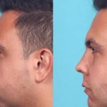 بوکال فت مردان: نکات و ویژگی‌های جراحی بوکال فت برای آقایان