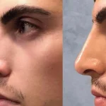 عوارض جراحی بینی بعد از چند سال