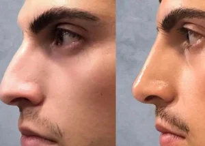 عوارض جراحی بینی بعد از چند سال