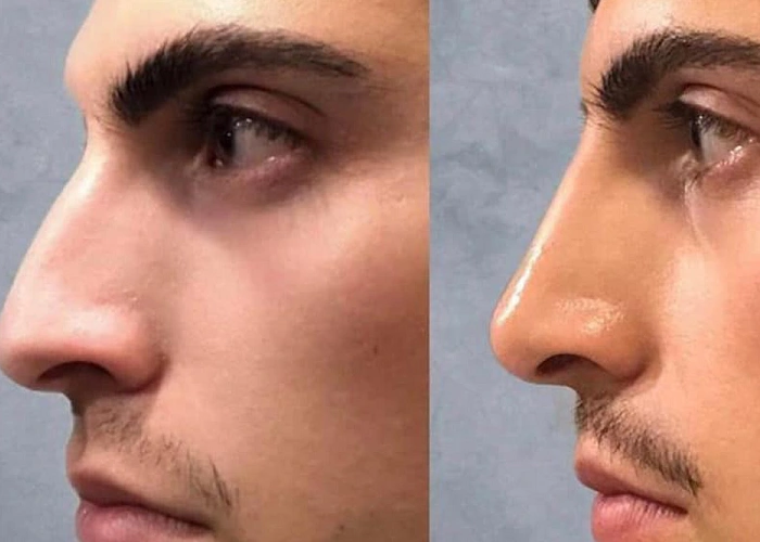 عوارض جراحی بینی بعد از چند سال
