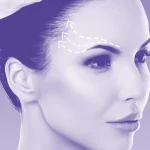 ماندگاری لیفت شقیقه