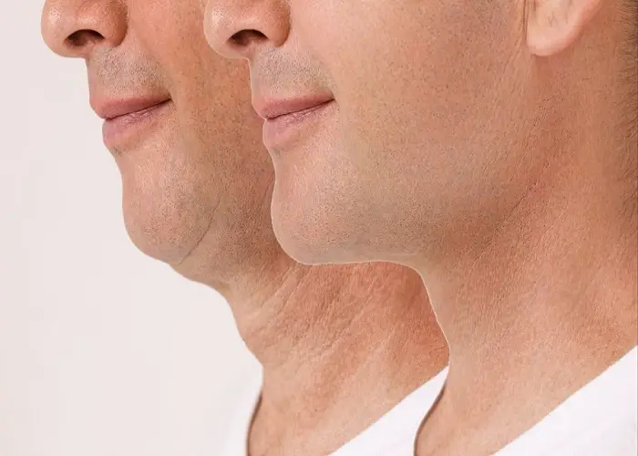لیپوماتیک برای غبغب هم کاربرد دارد؟