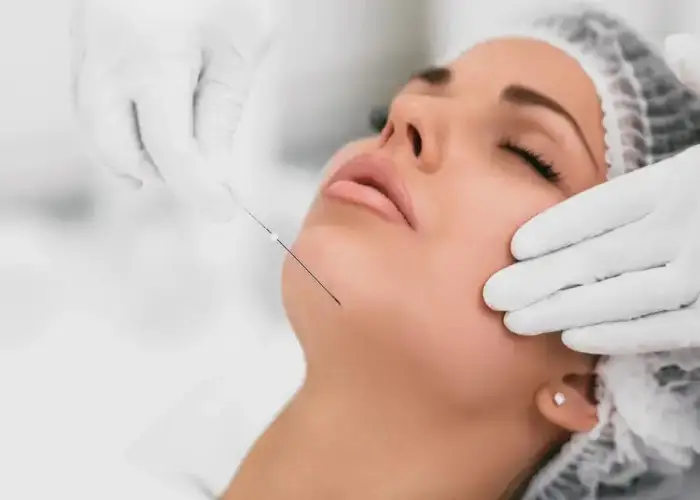 لیفت شقیقه با نخ