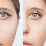 آیا لیفت ابرو باعث تغییر در دید چشم‌ ها می شود؟