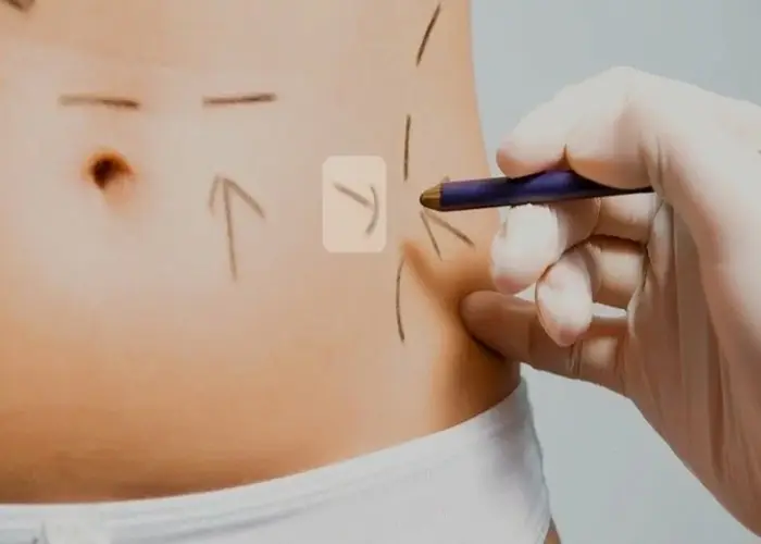 کاهش سایز با ابدومینوپلاستی