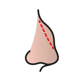 جراحی بینی استخوانی